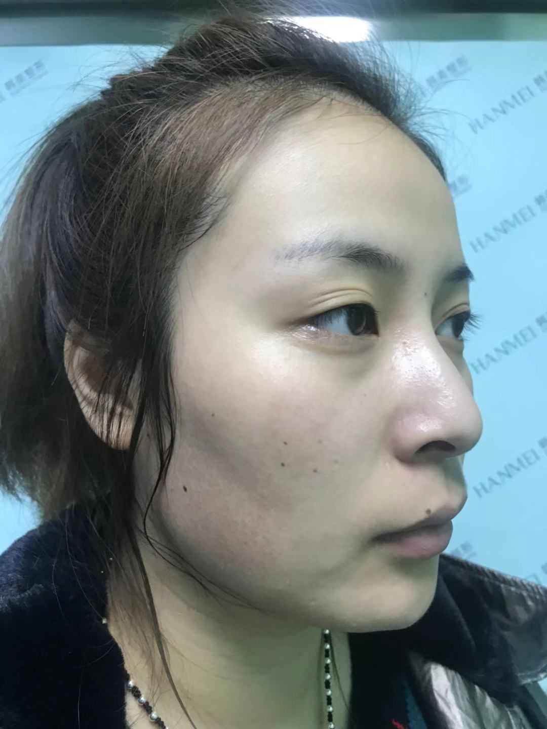 哈尔滨韩美医疗美容医院割双眼皮下颚角隆鼻