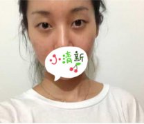 玉溪吴氏嘉美医美刘勤做双眼皮怎么样？案例分